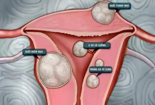 자궁근종: 자궁근종은 언제 제거해야 하고 언제 자궁적출술을 해야 하나요?