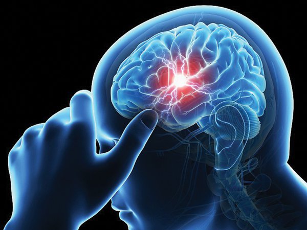 조영제 주입을 통한 뇌 관류 컴퓨터 단층 촬영 스캔