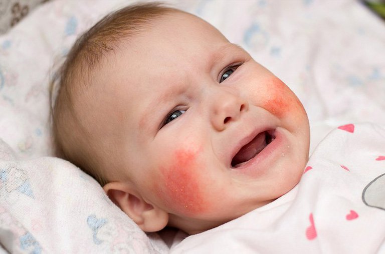 아기의 아토피 피부염을 돌보는 방법
