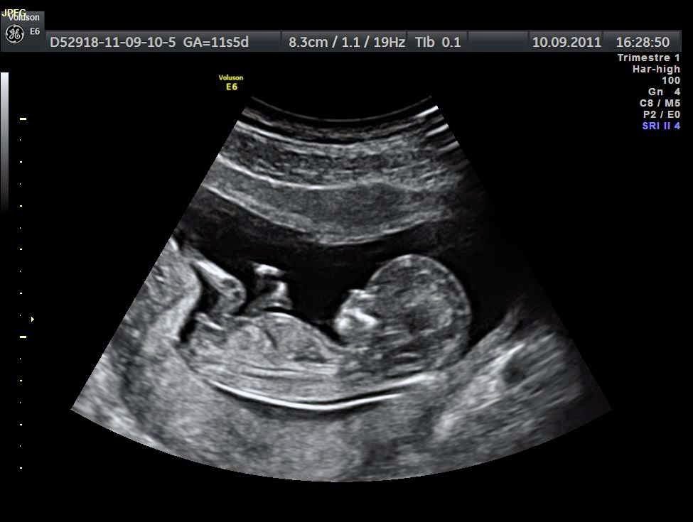 임신 25주차 임신 2분기 초음파 영상