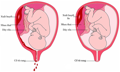 임산부가 갑상선 질환에 걸리기 쉬운 이유는 무엇입니까?