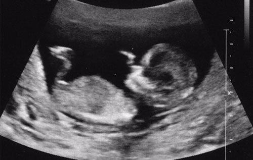 임신 첫 3개월의 초음파 영상