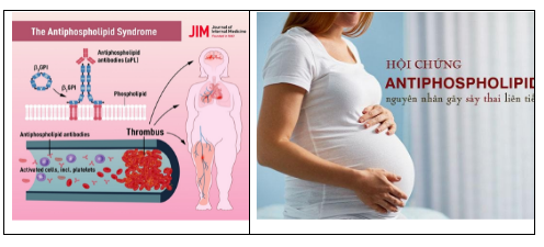 임산부의 항인지질 증후군(APS)