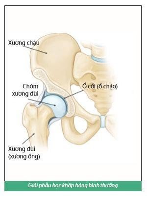 고관절 교체 재활