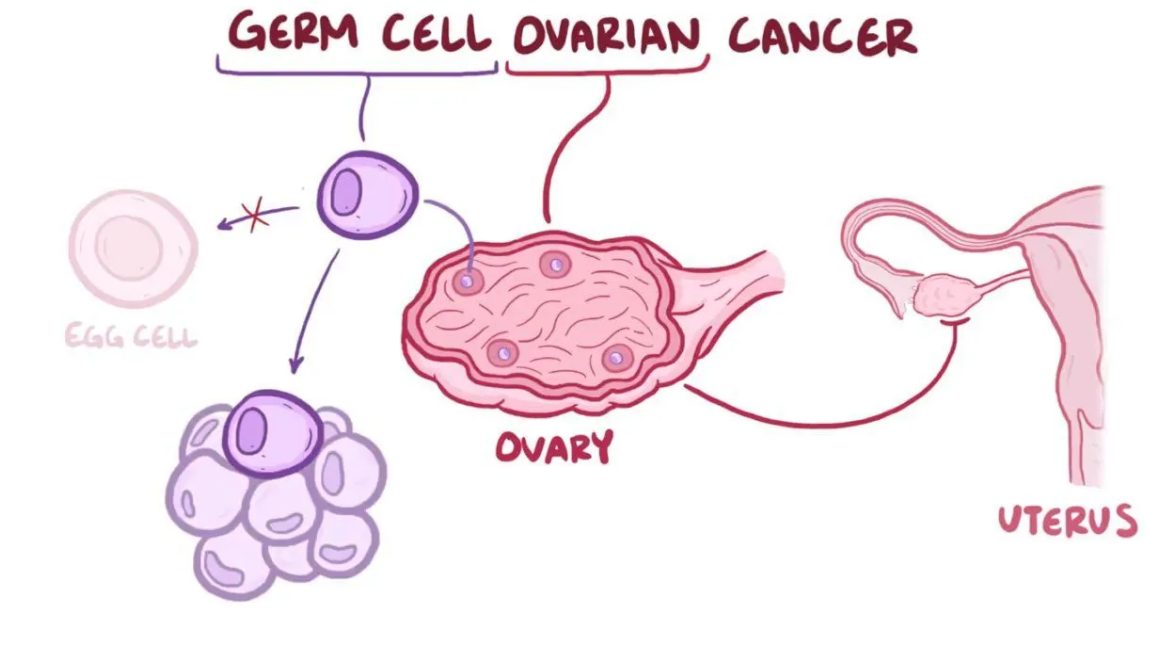 난소 생식 세포 종양