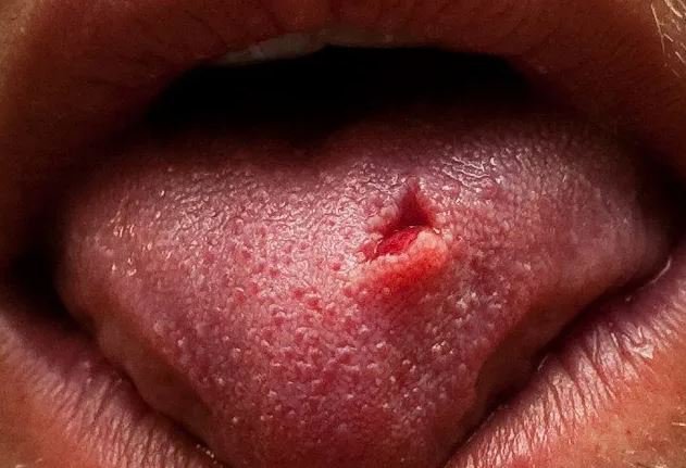 실수로 혀를 깨물면 부상과 혀 통증이 발생할 수 있습니다.