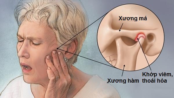 귀 근처의 턱 통증은 측두하악 관절 질환으로 인해 발생할 수 있습니다.