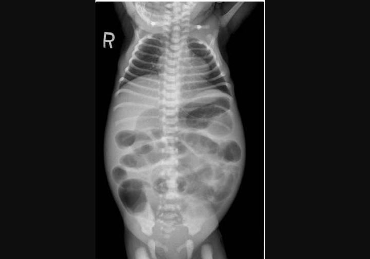 히르슈스프룽병이 있는 어린이의 복부 엑스레이