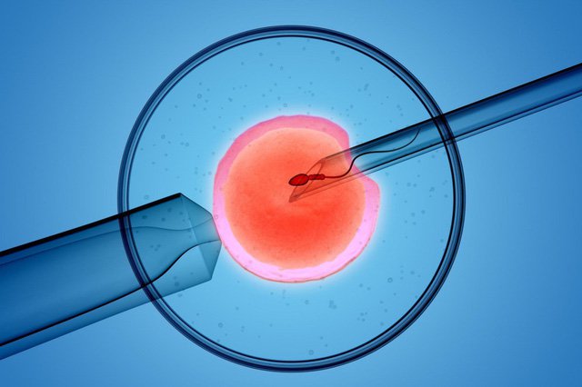 체외 수정 IVF