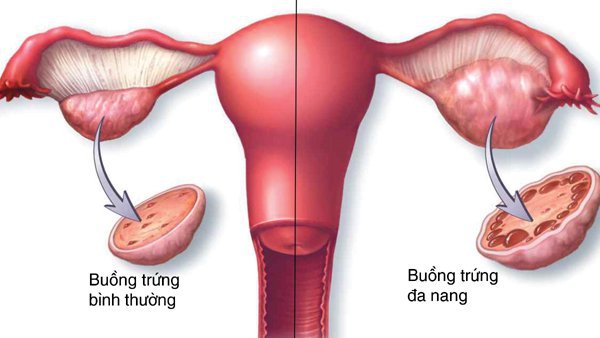 다낭성 난소