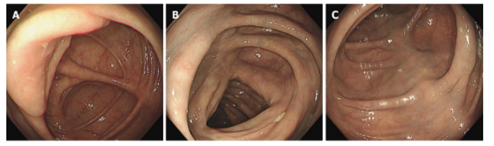 자발성 장간막 동맥경화증 환자의 내시경 사진.  그림 AC: 증례 3의 대장 내시경 검사에서 횡행 결장의 옅은 녹색 변색을 보여줍니다.