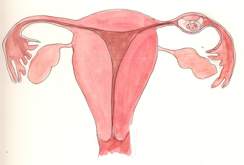 자궁외 임신은 위험합니까?