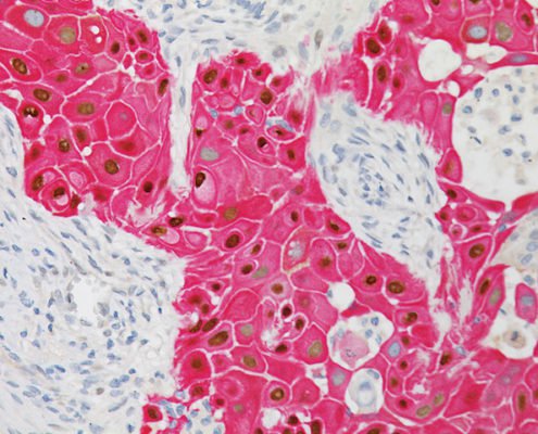 편평 세포 폐암