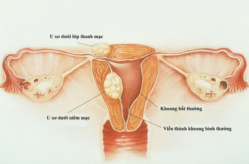 점막하 근종