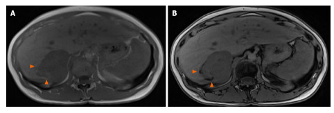 T1상 자기 공명 영상: 지방 침착(화살촉)으로 인한 병변 주변의 신호 감소.  A: 단계적으로;  B: 반대 위상.