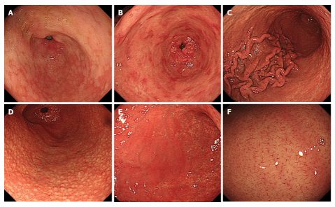 교토 분류의 내시경 결과