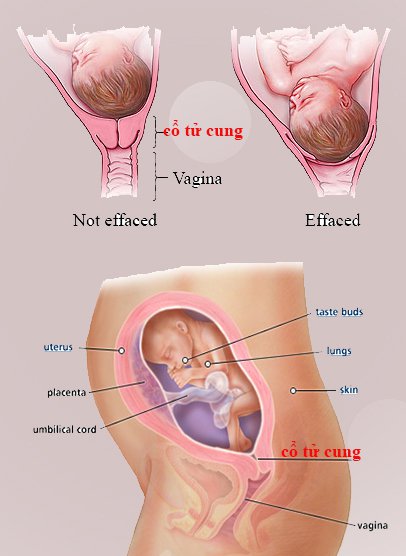 Vinmec의 자궁경부 봉합술로 임신 중 자궁외사증 치료
