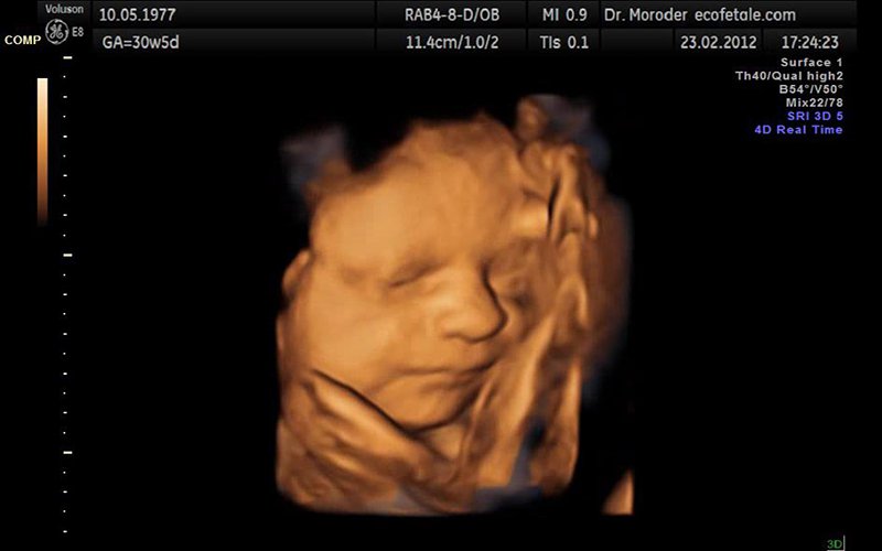 3D 임신 초음파