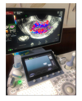 Vinmec IVF Center의 최신 Volusion E6 기계는 자궁내막증의 도플러 초음파를 수행하고 자궁강을 조사하며 배아 이식 실패의 원인을 찾는 데 사용됩니다.