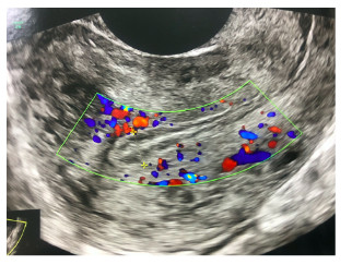 도플러 자궁내막 I형: 자궁의 근육층(요골동맥)에서 관찰되는 관류