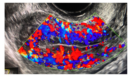 도플러 심내막염 III형: 심내막의 탈락막 전체로의 관류