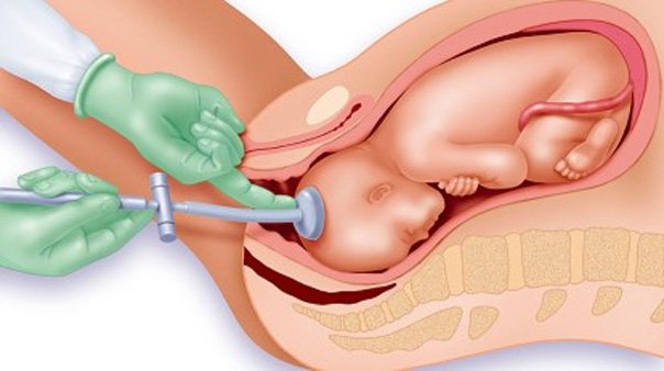 흡인 보조 분만은 산모가 임신 중에 출산을 하도록 돕는 절차입니다.