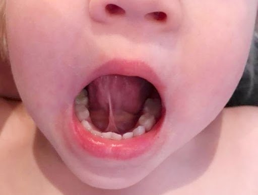 어린이의 혀 절단