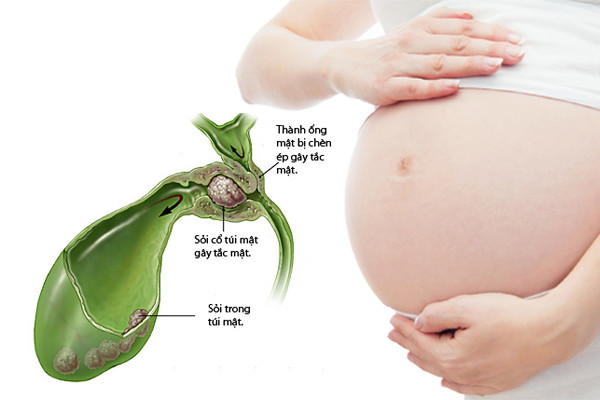 임신 중 담낭 질환