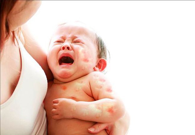 생후 4개월이 된 아기가 우유 단백질 알레르기가 있는데 어떻게 해야 할까요?