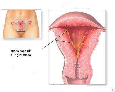산후 자궁 감염