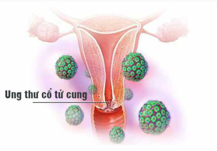 HPV와 자궁경부암