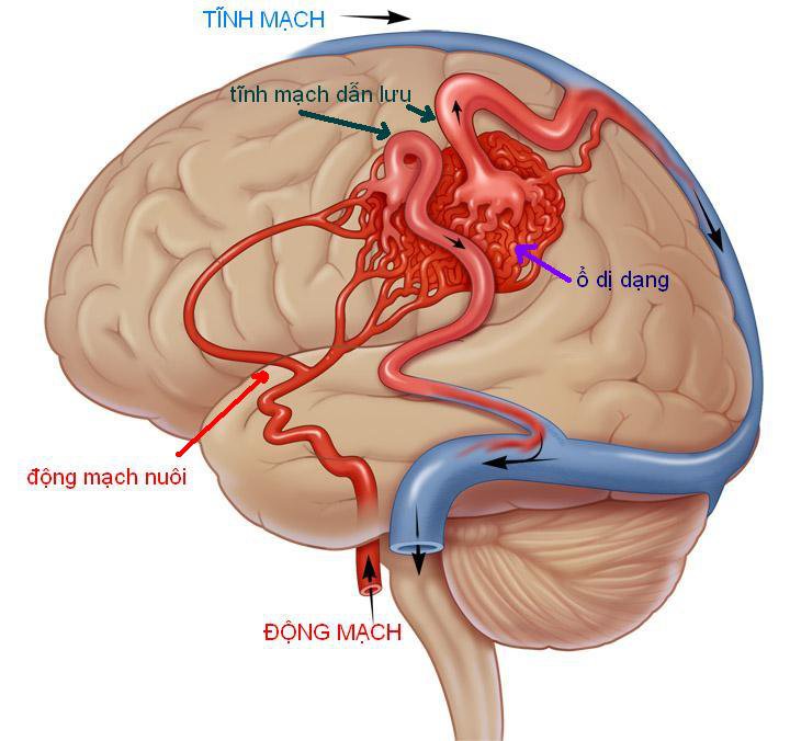 대뇌 동정맥 기형