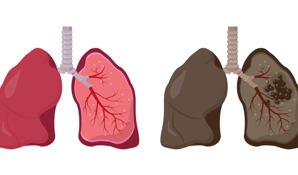 폐 낭종은 폐 조직 내에 형성되는 비정상적인 공기 또는 액체로 채워진 주머니 모양의 공간입니다.