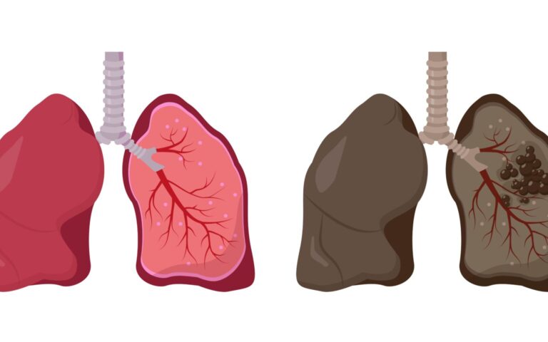 폐 낭종은 폐 조직 내에 형성되는 비정상적인 공기 또는 액체로 채워진 주머니 모양의 공간입니다.