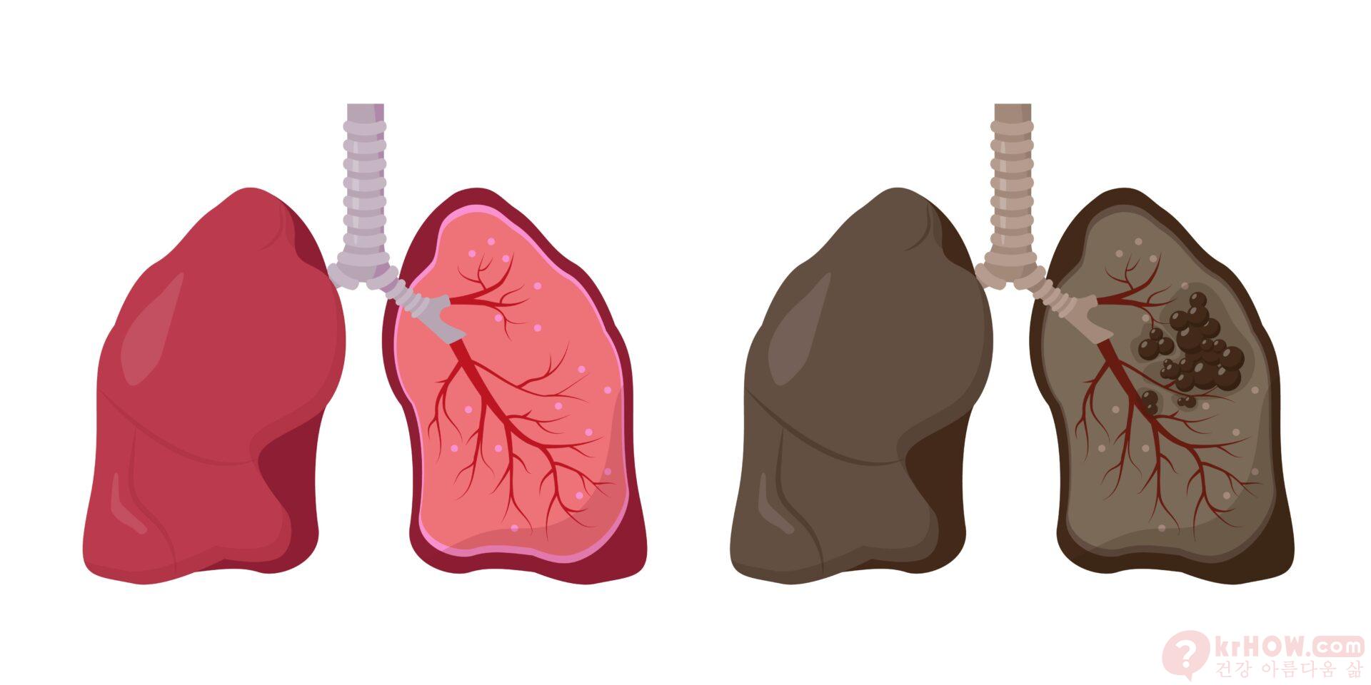 폐 낭종은 폐 조직 내에 형성되는 비정상적인 공기 또는 액체로 채워진 주머니 모양의 공간입니다.