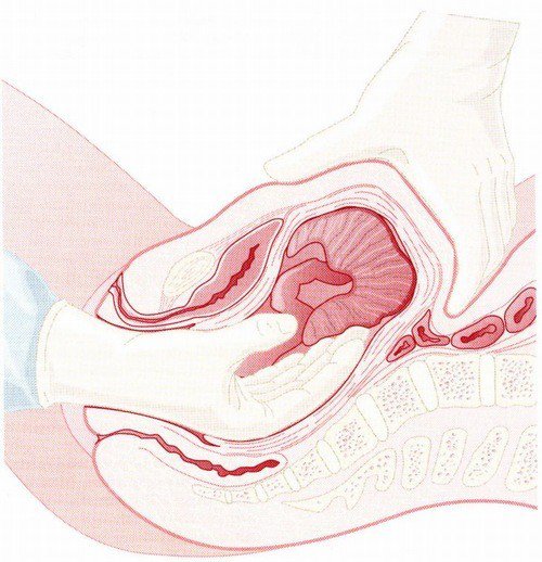 봉합 자궁 경부 열상