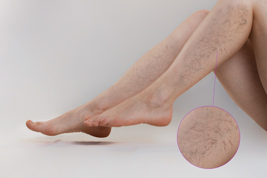 다리의 정맥류는 출산 후 여성에게 매우 흔합니다.