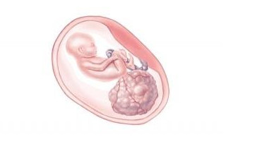 태아 절단 부위의 기형종 삽화.