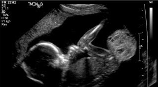 태아 기형종의 초음파 이미지.