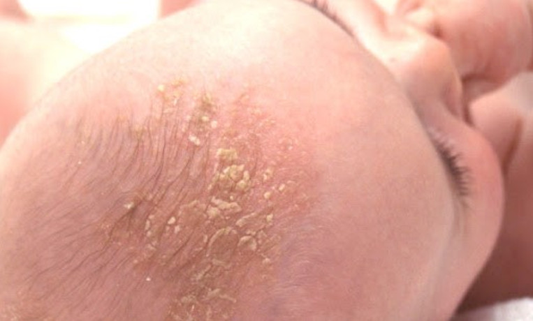 두피의 지루성 피부염은 유아에게 매우 흔합니다.